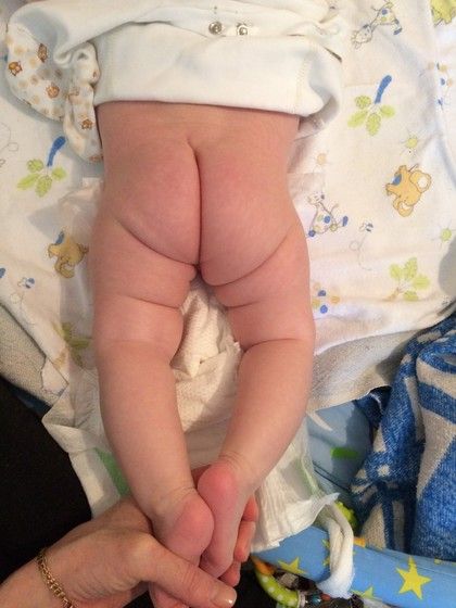 Если у новорожденного неровные складки Если у новорожденного неровные складки