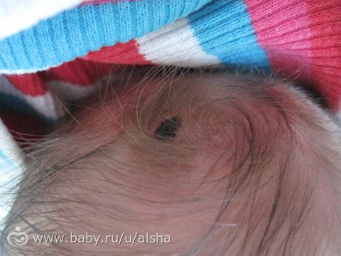 Травма ребенка во время прокола пузыря