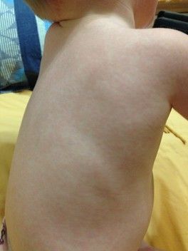 Опять я продолжение про сыпь у сына! Врачи как всегда не знают сказали ждите или пройдет или ... Опять я продолжение про сыпь у сына! Врачи как всегда не знают сказали ждите или пройдет или ...